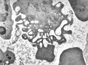 M,24y. | bone marrow - haemolytic anemia(ropalocyte - picturesque reticulocyte) M,24y. | bone marrow - haemolytic anemia(ropalocyte - picturesque reticulocyte)